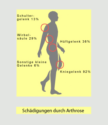 Schädigungen durch Arthrose